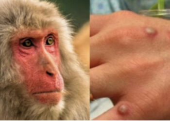 Lija e majmunëve, raportohen mbi 1000 raste në 29 vende