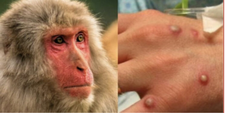 Lija e majmunëve, raportohen mbi 1000 raste në 29 vende