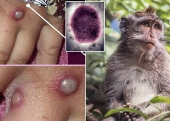 Lija e majmunit, identifikohet një rast i dyshimtë në Kosovë