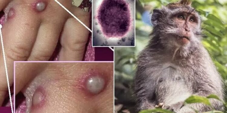 Lija e majmunit, identifikohet një rast i dyshimtë në Kosovë