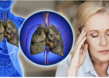 Këto 6 shenja, tregojnë se mëlçia juaj është e mbushur plot me toksina