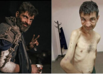 FOTO/ 4 cm kockë e munguar në krah, ndryshimi drastik i ushtarit ukrainas pasi u mbajt 4 muaj peng nga rusët