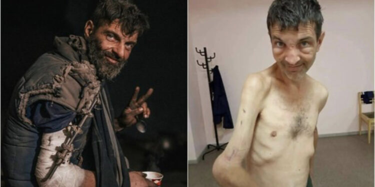 FOTO/ 4 cm kockë e munguar në krah, ndryshimi drastik i ushtarit ukrainas pasi u mbajt 4 muaj peng nga rusët