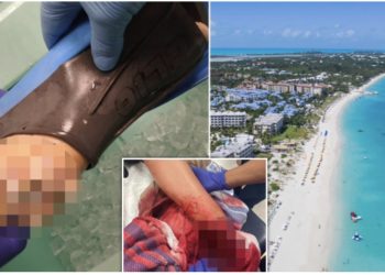 Shkoi për të festuar diplomimin në Karaibe, 22-vjeçarja humb këmbën nga kafshimi i peshkaqenit