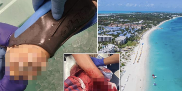 Shkoi për të festuar diplomimin në Karaibe, 22-vjeçarja humb këmbën nga kafshimi i peshkaqenit