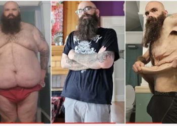 Burri që peshonte sa ‘një elefant’, mbetet me 18kg lëkurë të zbrazur pas humbjes drastike në peshë