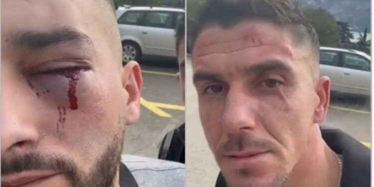 FOTO/ Kjo është gjendja e 3 shqiptarëve të dhunuar në Malin e Zi, ja detajet si ndodhi ngjarja