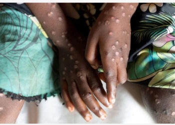 Lija e majmunëve shpallet emergjencë shëndetësore në Afrikë