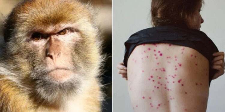 Alarm në Evropë/ Shënohet rasti i parë me linë e majmunëve