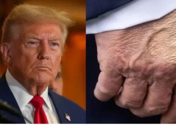 Shenja “e çuditshme” në dorën e Trump, ekspertët: Mund të jetë mavijosje për disa arsye! Shtëpia e Bardhë: Takon shumë amerikanë dhe u shtrëngon duart