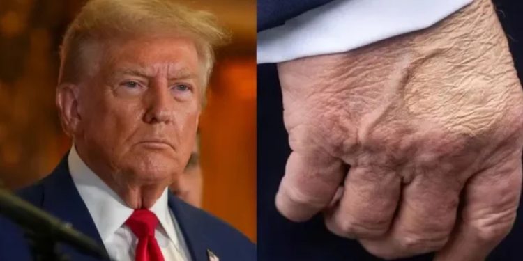 Shenja “e çuditshme” në dorën e Trump, ekspertët: Mund të jetë mavijosje për disa arsye! Shtëpia e Bardhë: Takon shumë amerikanë dhe u shtrëngon duart