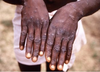 Regjistrohet vdekja e parë në Ganë për shkak të epidemisë së mpox-it