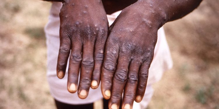 Regjistrohet vdekja e parë në Ganë për shkak të epidemisë së mpox-it