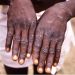 Regjistrohet vdekja e parë në Ganë për shkak të epidemisë së mpox-it