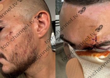 Shtetasi i huaj në Durrës sulmohet dhe grabitet, dëshmia e të riut për TCH: 5 persona më goditën me shkop dhe më prenë me thikë.