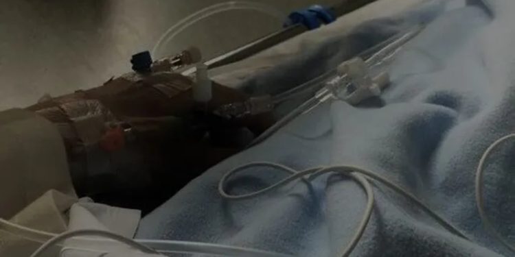 Viktima e plumbave nga atentati në Shkodër, familja e kamerieres 25-vjeçare kërkon ndihmë për shërimin e saj