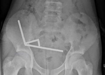 Doktorët në Zelandën e Re japin ndihmë duke nxjerrë dhjetëra magnete nga zorrët e një djali 13-vjeçar.