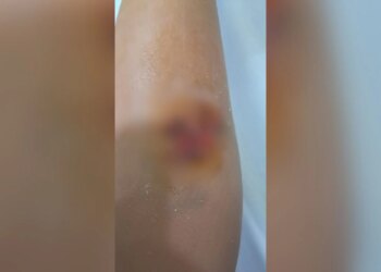 E rëndë: Një djalë 8-vjeçar goditet nga një qen endacak në Durrës