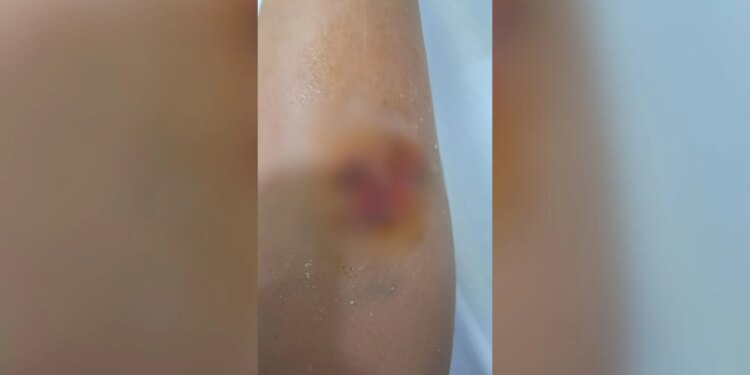 E rëndë: Një djalë 8-vjeçar goditet nga një qen endacak në Durrës