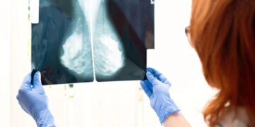 Revolucioni në terapi për kancerin e gjirit, një test i hulumtuesve britanikë parashikon terapinë më efektive për secilin pacient.