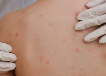 Alarm në SHBA, fruthi po përhapej në disa shtete/ Mjekët: Vaksinimi ka rënë në nivel të ulët