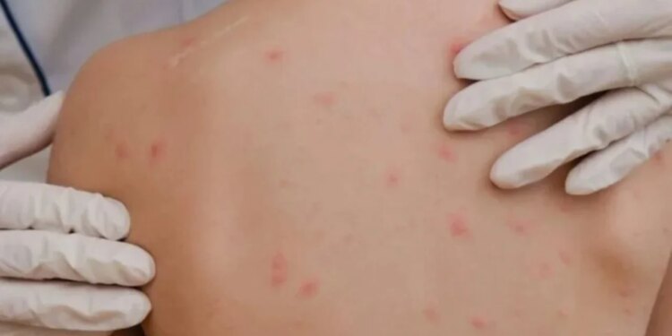 Alarm në SHBA, fruthi po përhapej në disa shtete/ Mjekët: Vaksinimi ka rënë në nivel të ulët