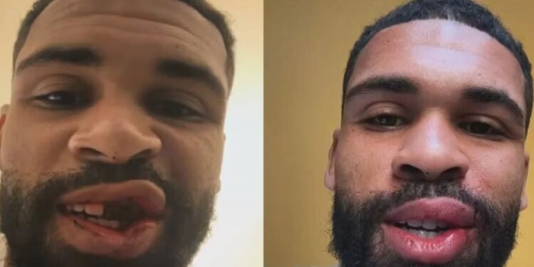 Loftus-Cheek ndan një foto pa dhëmbë, më pas shpreh falënderime për mbështetje: Pjesa më e vështirë ka përfunduar.