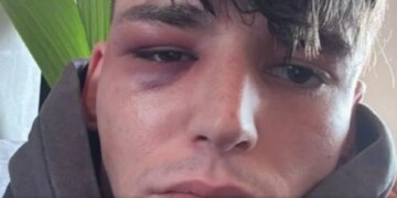 Ngjarje tronditëse në Këln; arbitri Kaiser sulmohet pas propozimit për martesë ndaj partnerit të tij…