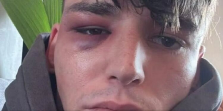 Ngjarje tronditëse në Këln; arbitri Kaiser sulmohet pas propozimit për martesë ndaj partnerit të tij…