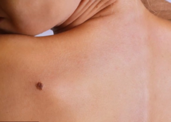 Mos neglizhoni nishanet: Dermatologët paralajmërojnë se ato mund të sinjalizojnë kancerin e lëkurës