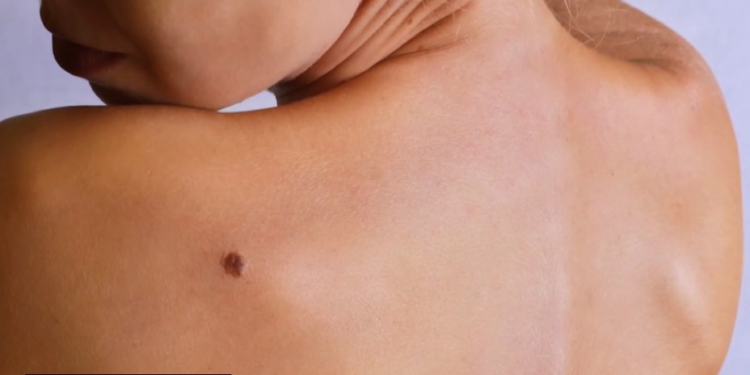 Mos neglizhoni nishanet: Dermatologët paralajmërojnë se ato mund të sinjalizojnë kancerin e lëkurës