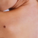 Mos neglizhoni nishanet: Dermatologët paralajmërojnë se ato mund të sinjalizojnë kancerin e lëkurës