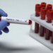 Shqipëria miraton për herë të parë Planin Kombëtar për Eliminimin e Hepatiteve Virale