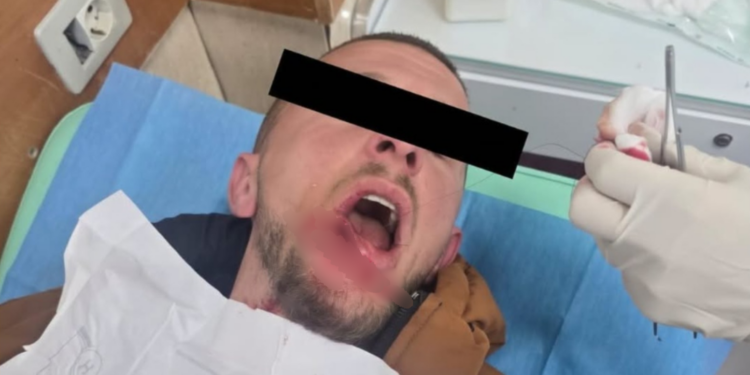 Stop plumbave mbi studentët — Berisha nxjerr foton e një protestuesi të lënduar në fytyrë, dyshohet me plumb gome